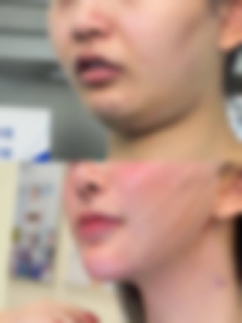 三、抽脂填胸全过程的修复时长