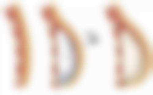 一、做了吸脂手术会反弹吗？先了解吸脂手术原理