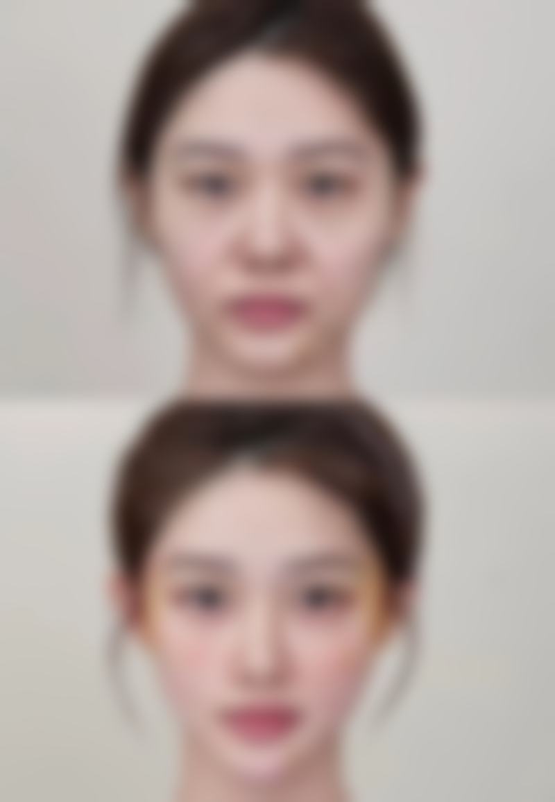 一、做双眼皮留下疤痕的原因