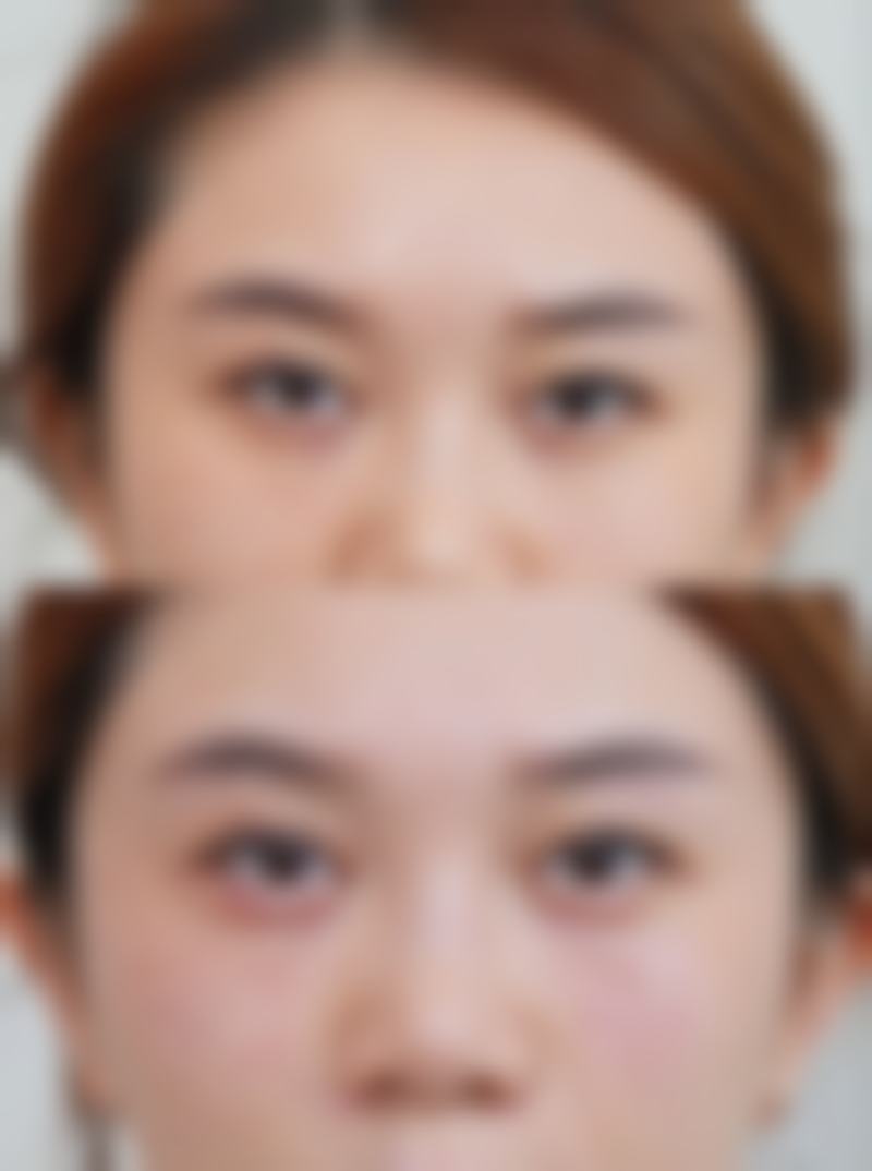 五、选择合适的医疗机构和医生做双眼皮埋线手术